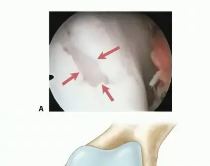 الترقيع الدقيق للغضروف (Microfracture): حلول مبتكرة لآلام الركبة في اليمن