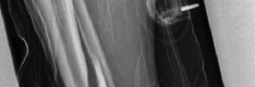 Illustration 18 for Tibial Fracture Extending into the Plafond: Intramedullary Secrets