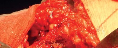 Illustration 22 for Posterolateral Surgical Approaches: Achieve Optimal Hip Replacement