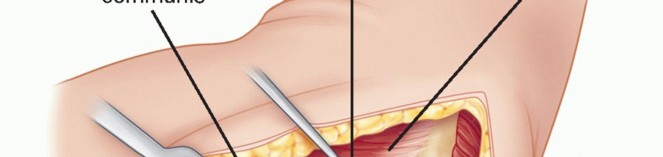 Illustration 8 for Radial Head Arthroplasty: Restoring Elbow Function & Stability