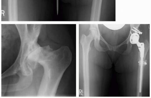 صورة توضيحية لـ إعادة بناء مفصل الورك المعقد لخلع الورك التنموي (DDH) باستخدام ترقيع رأس الفخذ الذاتي في صنعاء