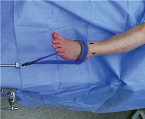 Illustration 4 for First Metatarsal Surgery: Expert Solutions for Foot & Ankle Pain