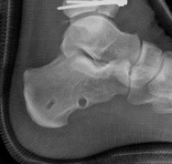 Illustration 21 for Complex Tibial Shaft Fracture: Plate Fixation for Plafond Extension