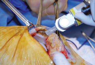 Illustration 65 for Knee Arthroplasty: Avoiding Pitfalls & Benefiting from UKA