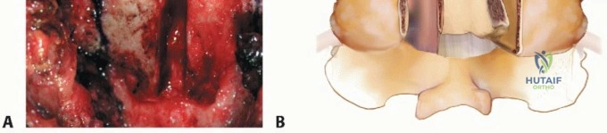 Coracoacromial Ligament Transfer for Chronic Acromioclavicular Joint Dislocation