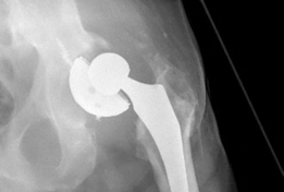 Illustration 5 for Acetabular Revision: Solving Challenges Post Two-Stage Arthroplasty
