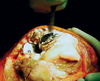 Illustration 20 for Revision of Failed UKA: Your Guide to Successful Treatment