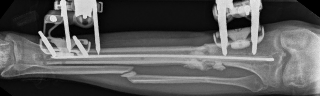 Illustration 12 for Tibial Fracture Extending into the Plafond: Intramedullary Secrets