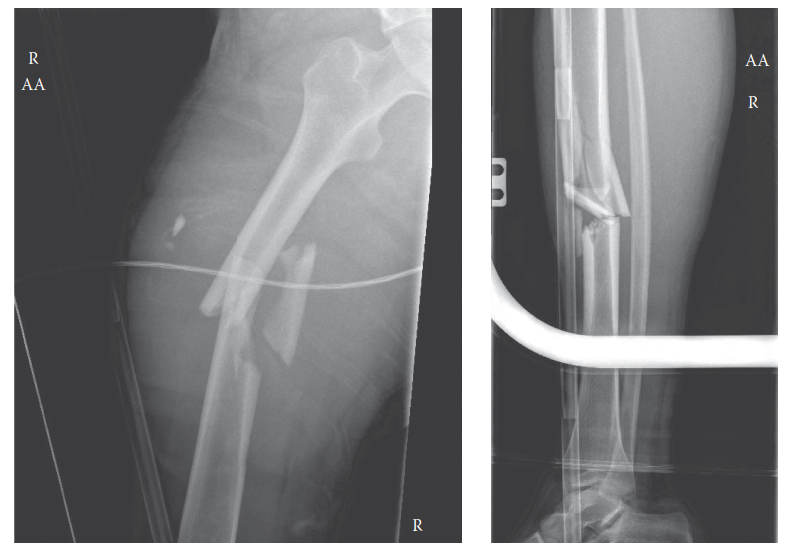 Illustration of floating knee floating - Dr. Mohammed Hutaif