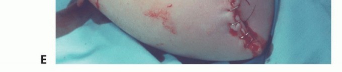 صورة طبية: بتر الذراع فوق وتحت الكوع: متى ولماذا يصبح ضرورة طبية؟ دليل شامل من الأستاذ الدكتور محمد هطيف