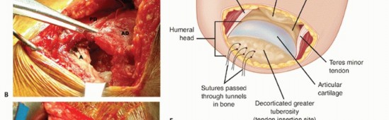 Illustration 12 for Restore Shoulder Function with Latissimus Dorsi Tendon Transfer