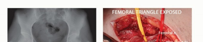 توضيح طبي: جراحة نقائل الحوض: حل شامل لآلام العظام واستعادة الحركة مع الأستاذ الدكتور محمد هطيف