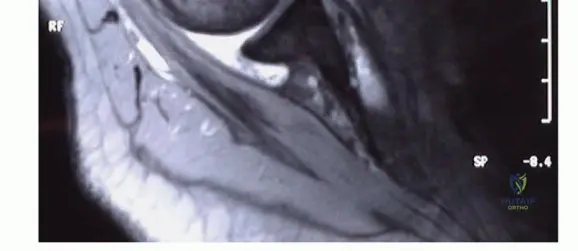 Illustration of angle of approach - Dr. Mohammed Hutaif