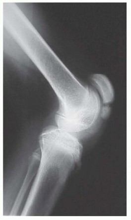 Optimize Gait: Surgical Lengthening for Medial Hamstring Muscles