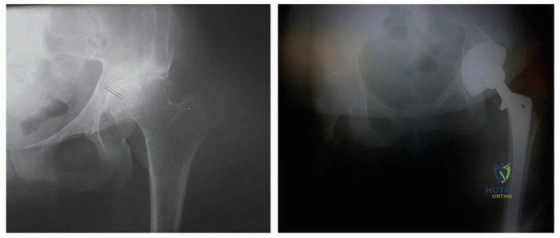 صورة توضيحية لـ إعادة بناء مفصل الورك المعقد لخلع الورك التنموي (DDH) باستخدام ترقيع رأس الفخذ الذاتي في صنعاء