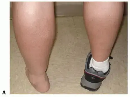 تثبيت مفصل الكاحل والقدم الخلفية بالمسامير النخاعية: الحل النهائي لآلام وتشوهات القدم الشديدة