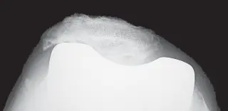 صورة توضيحية لـ تطعيم عظم الرضفة: دليل شامل لاستعادة وظيفة الركبة وتخفيف الألم في صنعاء