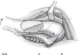 Illustration 3 for Solving Unstable SCFE: Subcapital Realignment with Extended Retinacular Flap