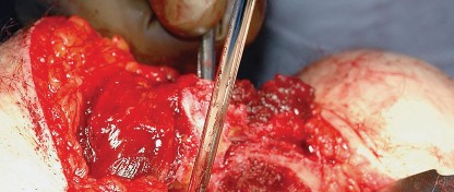 Illustration 48 for Unlock the Figure Posterior Approach to the Hip