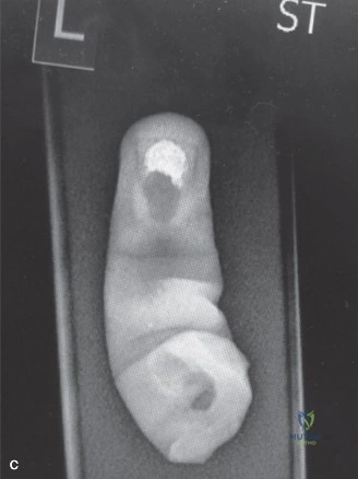 Illustration of degloving or complete - Dr. Mohammed Hutaif