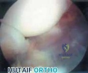 Derotational High Tibial Osteotomy for Patellofemoral Instability: A Comprehensive Surgical Guide