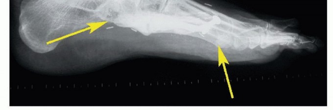 صورة طبية: أورام القدم: دليلك الشامل للعلاج، البتر، والاستئصال مع الأستاذ الدكتور محمد هطيف في صنعاء