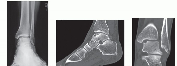 The Talus Microfracture Perspective: Is it Truly Effective?