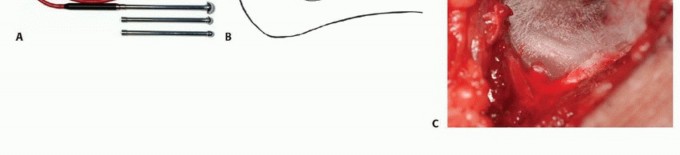 صورة طبية: تجنب الجراحة الكبرى: علاج أورام العظام بالنيتروجين السائل بتقنية الصب المباشر