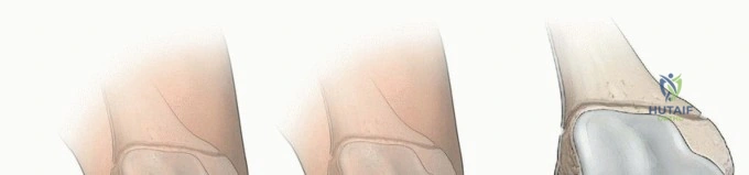 Peripheral Nerve Injuries: Comprehensive Operative Management