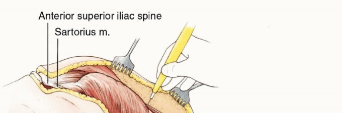 صورة توضيحية لـ استئصال نصف الحوض بالرفرفة الأمامية: حلول متقدمة لأورام الحوض الصعبة مع الأستاذ الدكتور محمد هطيف في صنعاء