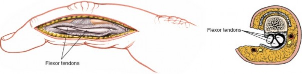 Illustration 161 for Essential Surgical Approaches: Uncover Every Aspect of the Wrist