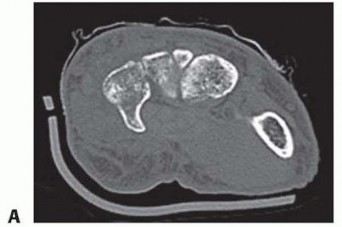 Surgical Treatment of Carpal Bone Fractures Excluding the Scaphoid