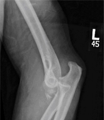 Complex Elbow Dislocation: Demystifying the Posteromedial Case