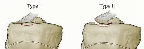 كسور الشوكة الظنبوبية: دليل شامل للمرضى للتعافي والعودة للحياة الطبيعية مع الأستاذ الدكتور محمد هطيف