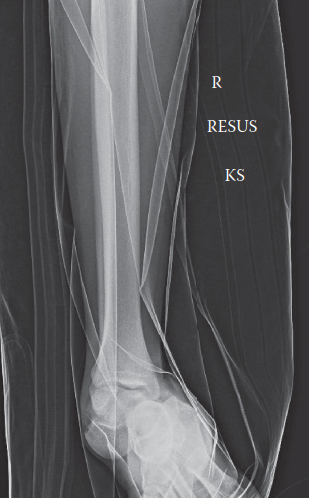 Medial Subtalar Dislocation: A Comprehensive Clinical Case & Imaging Guide