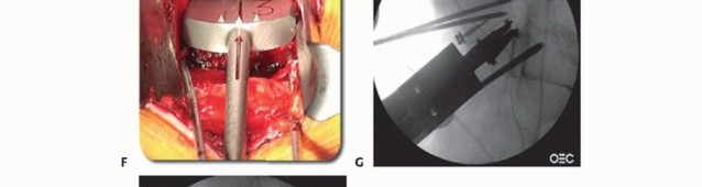 Illustration 16 for Anterior Lumbar Interbody: Fusion, Disc Replacement & Pain Relief