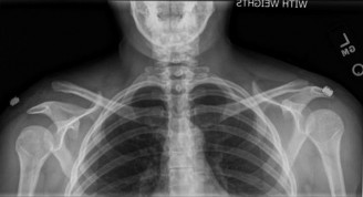 Illustration 43 for Right Shoulder Pain? Avoid This Common X-ray Mistake.