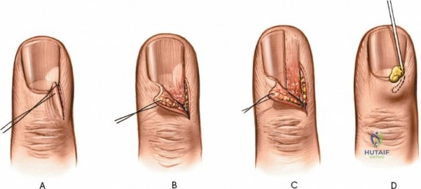 Paronychia: Comprehensive Surgical Management, Anatomy & Indications