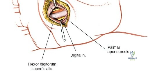 Image demonstrating entry into the medial midpalmar space