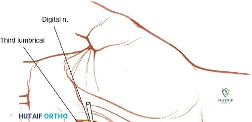Image showing placement of a drain in the palmar space