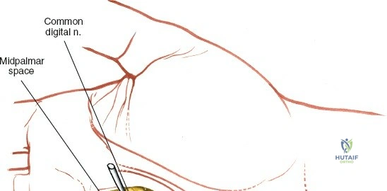 Image demonstrating a hand exercise for rehabilitation