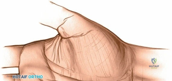 Illustration 1 for How to Safely Drain the Medial Midpalmar Space