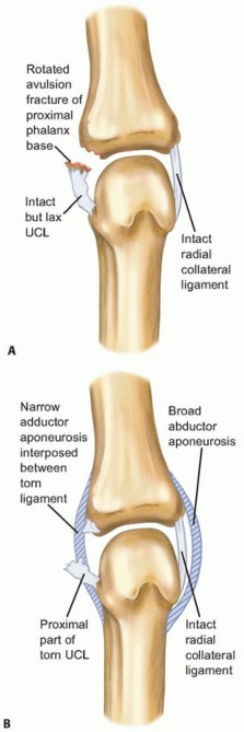 Illustration of collateral ligament disruptions - Dr. Mohammed Hutaif