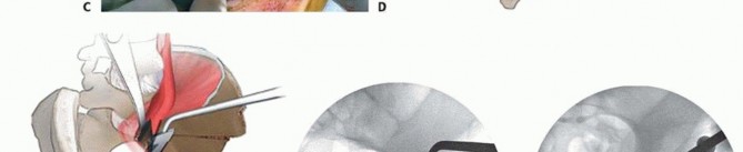 Illustration 21 for Restore Hip Health: Pelvic Osteotomy for Acetabular Dysplasia & CEA of Less