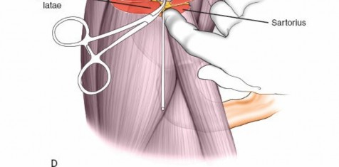Illustration 27 for Expert Guide: Ulna and Wrist External Fixation Pin Placement