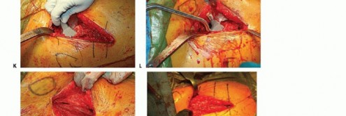 صورة طبية: نصف مفصل الورك: دليلك الشامل لدواعي الاستخدام والأنواع في صنعاء