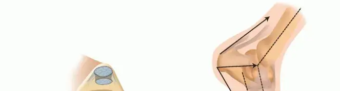 صورة توضيحية لـ كسر العظم السمسماني في إبهام القدم: دليل شامل للمرضى من التشخيص للعلاج والتعافي