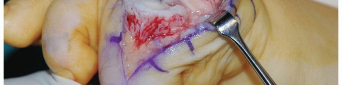 Illustration 15 for MTP Joint Arthrodesis: The Key to Optimal Toe Positioning