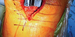 Illustration 46 for Mastering TKA: Essential Methods of Rotational Alignment