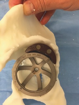 Illustration 5 for How We Tackled Massive Bone Loss in a Revision Hip Arthroplasty